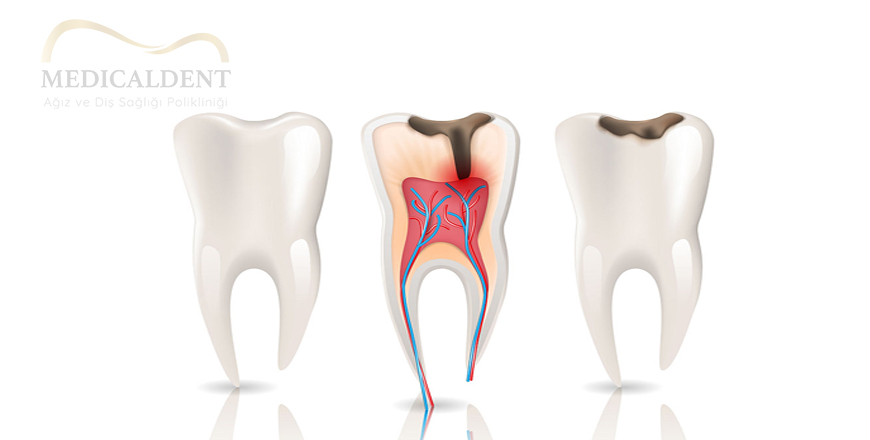 3 Symptoms for Root Canal Treatment