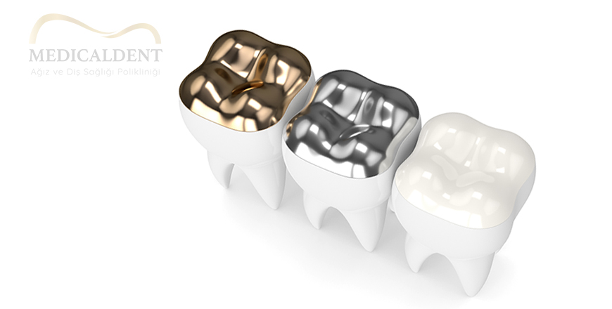 Properties of Tooth Filling